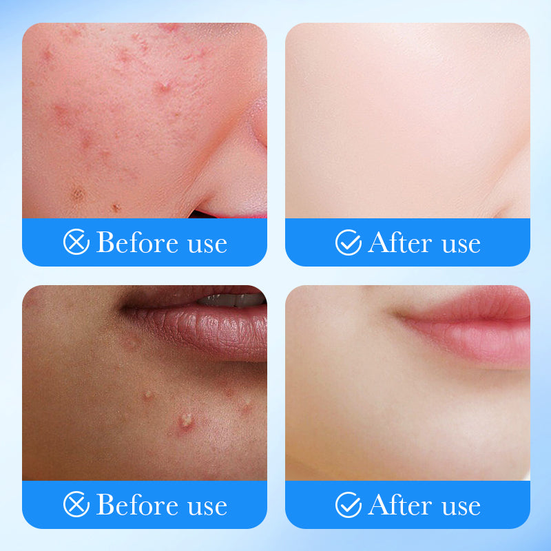 SADOER Salicylic Pimple Patch