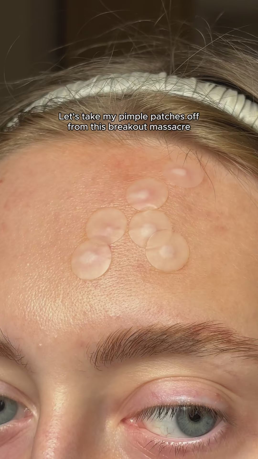 SADOER Salicylic Pimple Patch